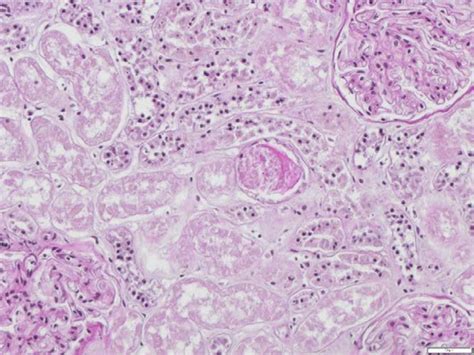 Acute Tubular Injury With Cytoplasmic Vacuolization Blebbing And Loss