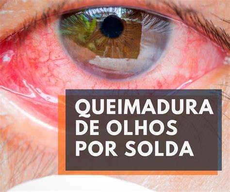 Queimadura De Olhos Por Solda O Que Fazer