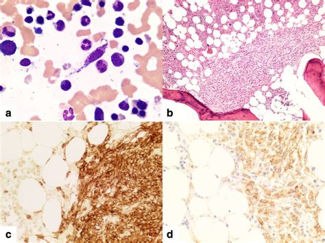 A Bone Marrow Aspirate Showing The Presence Of Spindleshaped Mast Cells