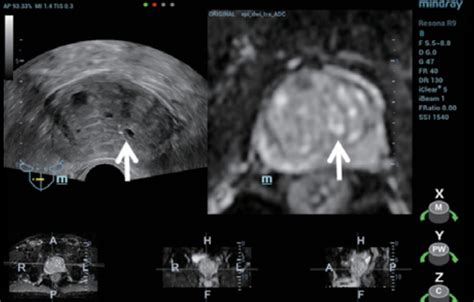 Ultrasound Journal Improving Diagnostic Accuracy With Trus Mri