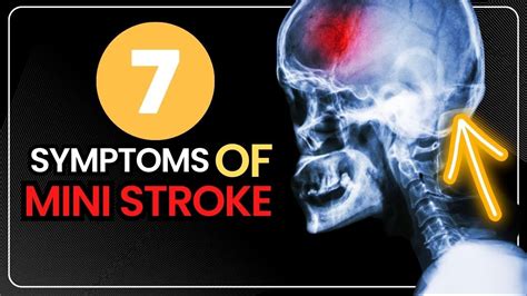 7 Symptoms Of Mini Stroke Transient Ischemic Attack Tia Signs