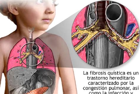 Las Enfermedades Hereditarias Más Comunes Grantitan