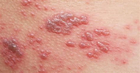 Two Out Of Three Older Aussies Haven T Had A Free Shingles Vaccine