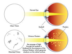 Flashes and Floaters - Nader Moinfar, MD, MPH, FACS, FASRS