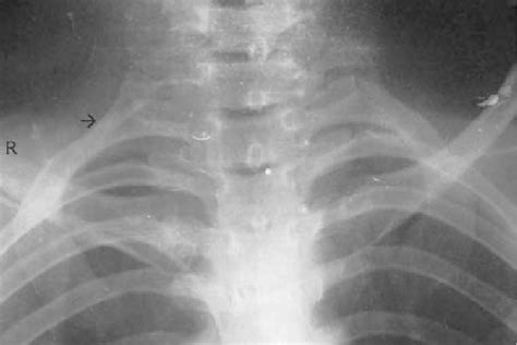 Pa View Of Chest X Ray Showing A Well Formed Rightsided Cervical Rib Download Scientific