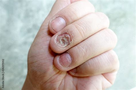 Close Up Of Fungus Nail Infection Fungal Infection On Nails Hand