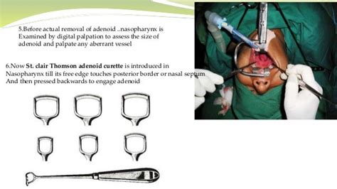 Presentation adenoidectomy