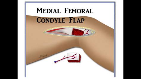 Medial Femoral Condyle Flap Youtube