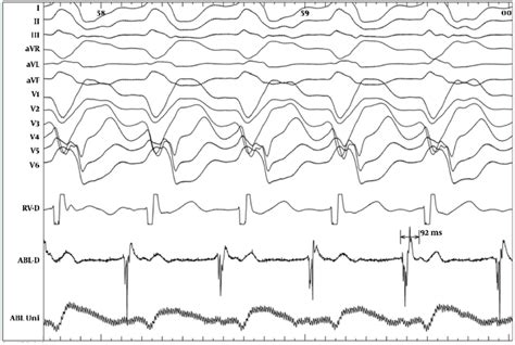 Intracardiac Recording During Monomorphic VT Tachycardia With LBBB