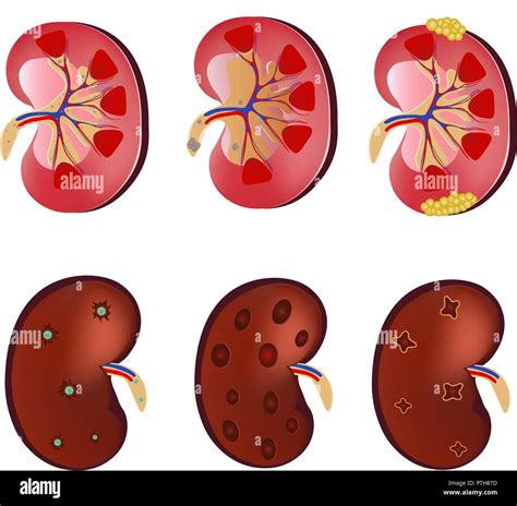 Lanatomie Réaliste 3d Vector Set Rein Rein Normal Une Infection