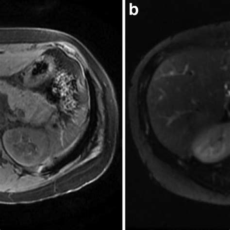 Axial T1 Left And T2 Fat Saturated Right Mri Images Demonstrate A