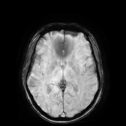 Trigeminal Cystic Schwannoma Image Radiopaedia Org