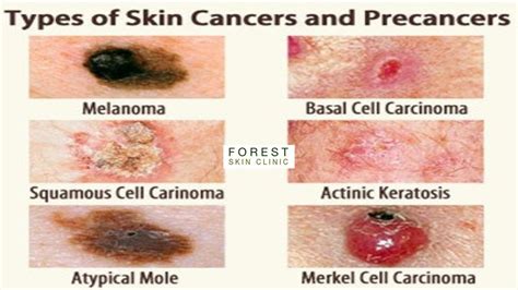 Appearance Of Skin Cancer Types