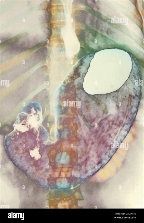 Gastric Ulcer Coloured X Ray Of A Stomach Containing A Gastric Peptic