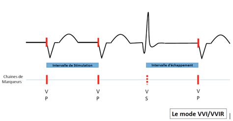 Traditional pacing modes | Cardiocases