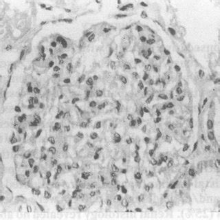 Glomerulus Showing Diffuse Mesangial Cell Proliferation H E X