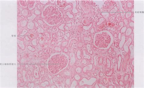 图2 3 32 急性弥漫性增生性肾小球肾炎 人体解剖学与组织生理病理学 医学