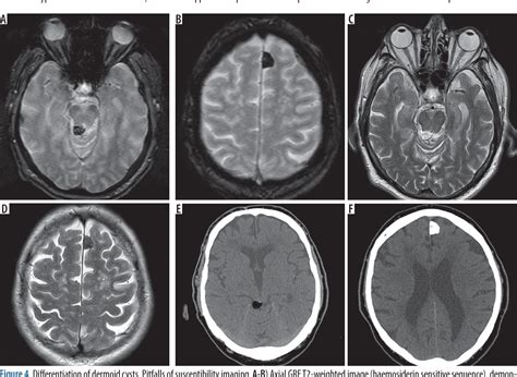 Dermoid Tumor Brain Mri