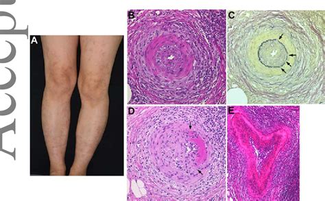 Figure 2 From Reappraisal Of Histopathology Of Cutaneous Polyarteritis