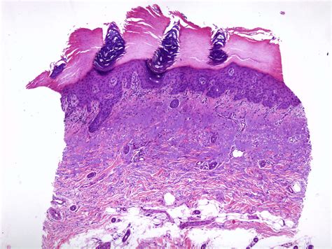 Actinic Keratosis Histology