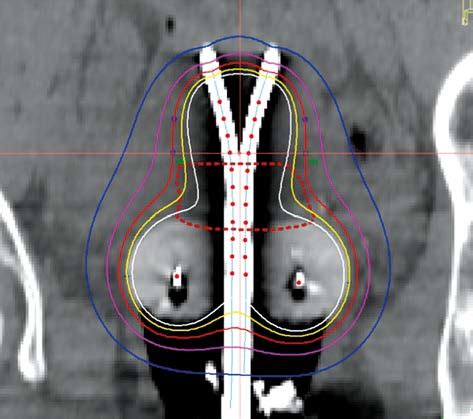 Representative Coronal Image From The Final Brachytherapy Plan The