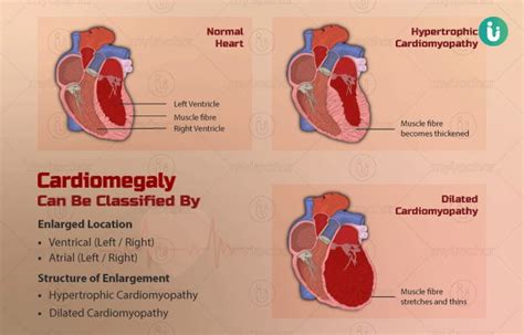 Enlarged Heart symptoms, causes, treatment, medicine, prevention, diagnosis