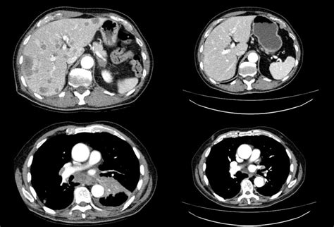 New Approaches To Metastatic Lung Cancer Medical Forum