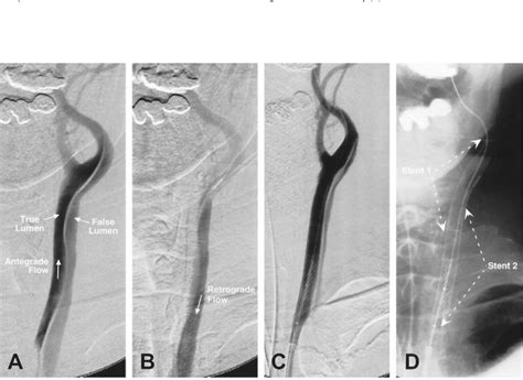 An 83 Year Old Man Patient 4 With A History Of Aortic Dissection