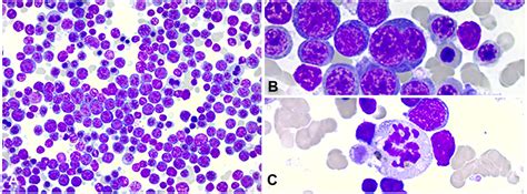 Anti Cd Antibody Immunohistochemistry In The Diagnosis Of Acute