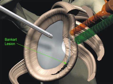 Shoulder Bankart Repair Surgery | Bone Clinic & Neurosurgeon