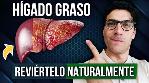 Cómo Revertir el Hígado Graso Naturalmente YouTube