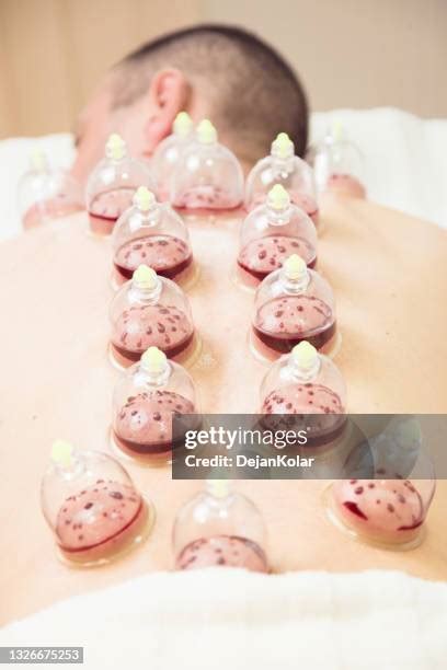 Wet Cupping Therapy Photos And Premium High Res Pictures Getty Images