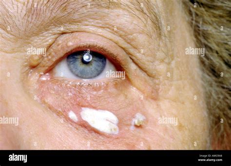 A Photograph Showing The Development Of Xanthelasma Palpebra A Common