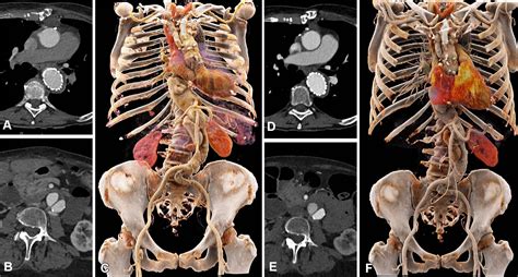 Photon Counting Ct Enables Lower Contrast Media For Aortic Imaging