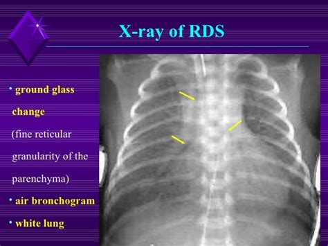 Respiratory Distress Syndrome Rds