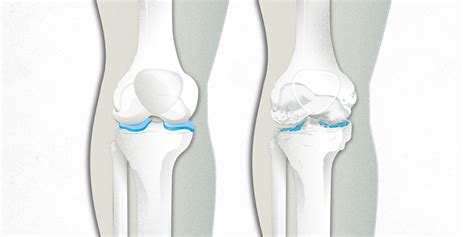 Artrosis Causas Síntomas Y Tratamiento PortalclÍnic