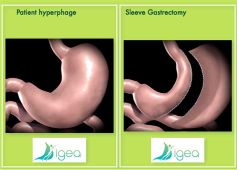 Patient Hyperphage Indication Sleeve Gastrectomie Dr SALSANO