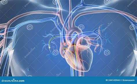 Opening the Occluded Artery by Inserting a Stent Stock Illustration ...