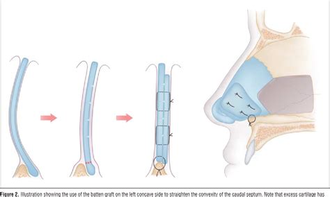 Septal Batten Graft To Correct Cartilaginous Deformities In Endonasal