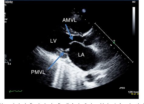 Figure 4 From Echocardiography In Mitral Stenosis Semantic Scholar