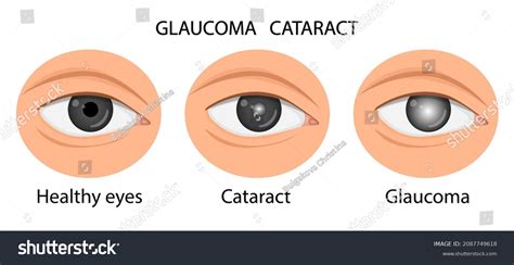 Illustration Healthy Eye Glaucoma Cataract Stock Vector Royalty Free 2087749618 Shutterstock