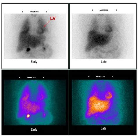 Cardiac Scintigraphy With I Mibg Of A Study Patient At The Anterior