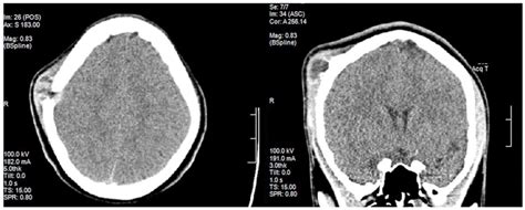 Ct Head Showing A Lytic Lesion In The Right Parietal Bone Download