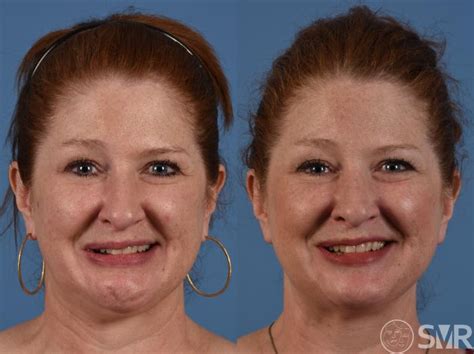 Botox®️ For Synkinesis Before And After Photo Gallery Dallas Tx