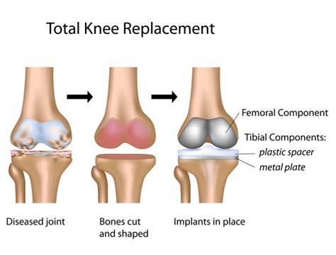 Knee Replacement Surgery & Makoplasty - GaiaGuides.com