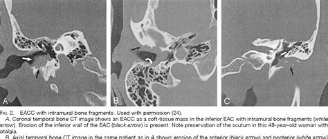 Cholesteatoma X Ray