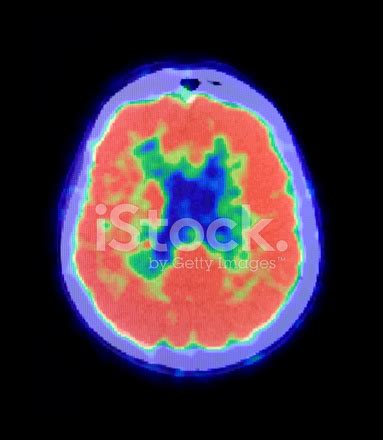 Human Brain Pet Scan Stock Photo | Royalty-Free | FreeImages