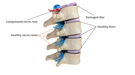 Difference Between Herniated And Bulging Discs Pain Doctor