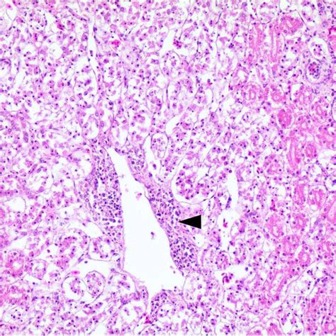 Intestine Necrotic Enteritis Marked Inflammation Mainly Consisted Of