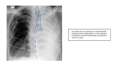 Signos De Pulm N Y Colapso Lobular Cap Ppt